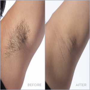 Deep pit hair removal (20 mins)