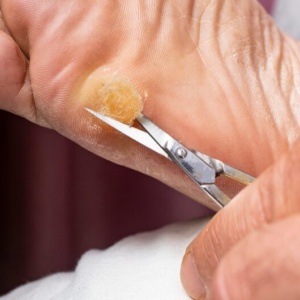 Callus removal (30 mins)