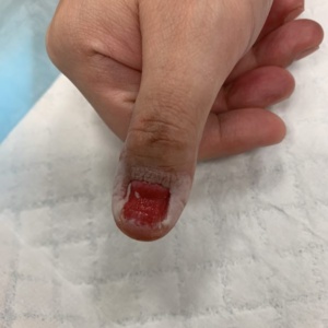 Nail removal (60 mins)